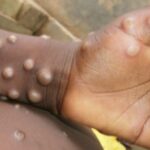 Mpox Death Toll Surpasses 570 as Congo Awaits Vaccine Arrival