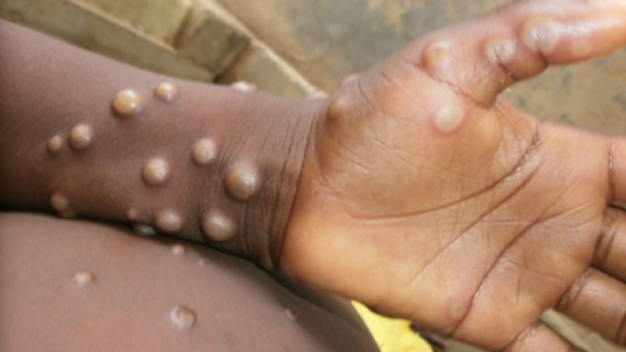 Mpox Death Toll Surpasses 570 as Congo Awaits Vaccine Arrival