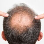 Regrow Your Hair Naturally: Tips to Prevent Hair Loss