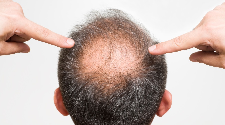 Regrow Your Hair Naturally: Tips to Prevent Hair Loss